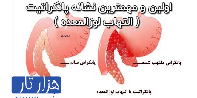 پانکراتیک چیست-التهاب لوزالمعده چیست