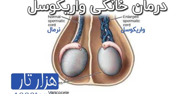 درمان خانگی واریکوسل
