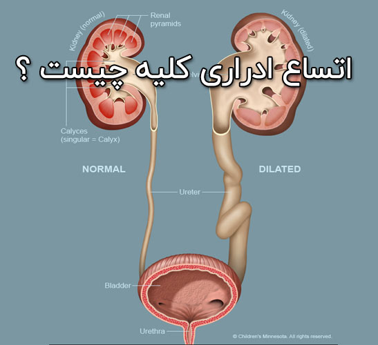 اتساع ادراری کلیه چیست