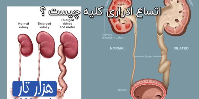 اتساع ادراری کلیه چیست