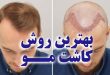 بهترین روش کاشت مو