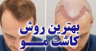 بهترین روش کاشت مو