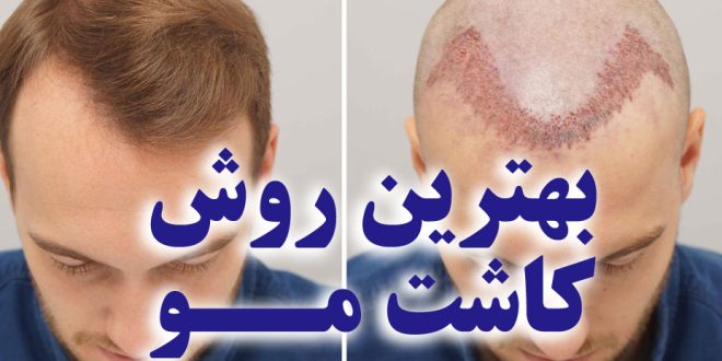 بهترین روش کاشت مو